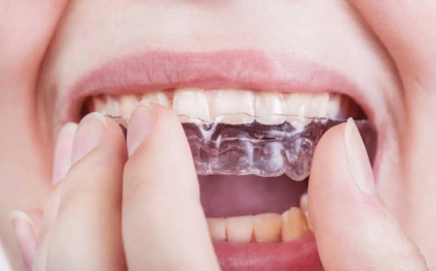 You definitely need to have baking soda at hand if you&rsquo;re wearing retainers