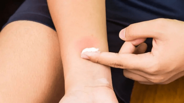 Baking soda is also effective in your battle against the bug bites
